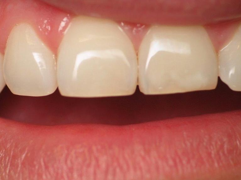 Dental-Bonding-in-Jonesboro-AR-After-Image