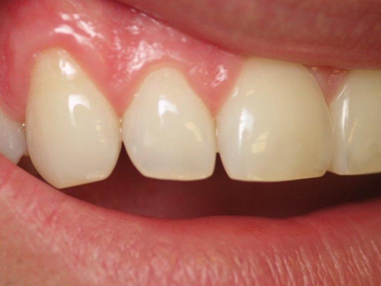 Dental-Bonding-in-Jonesboro-AR-Before-Image