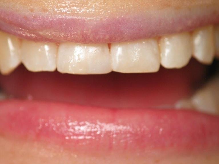 Veneers-in-Jonesboro-Arkansas-After-Image