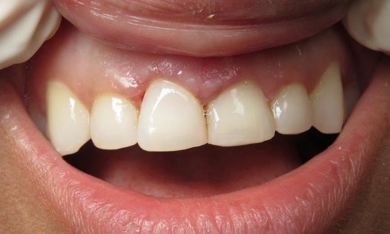 patient after veneers | jonesboro ar dentist