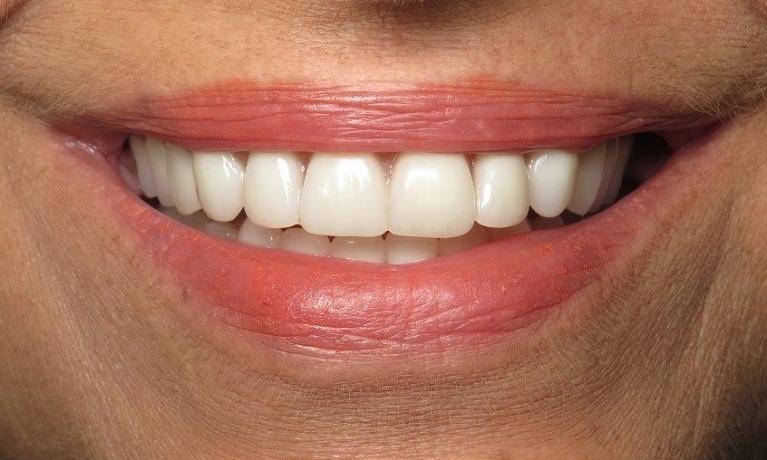 Dentures-After-Image