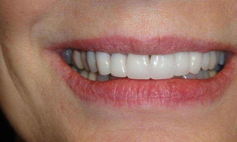 Patient after receiving new crowns