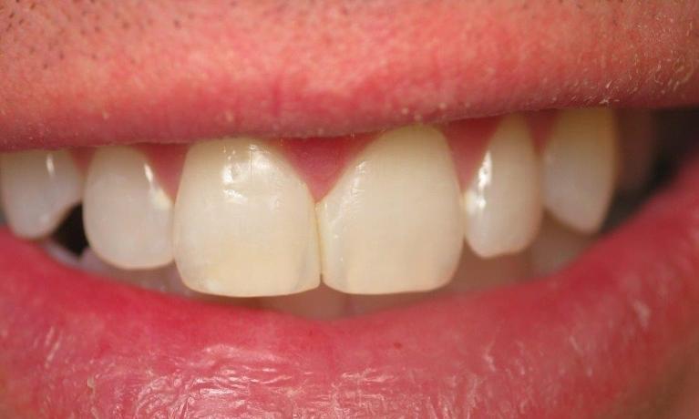 Patient after receiving bonding from Bartels Family Dentistry