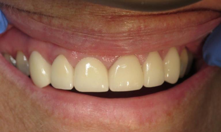 patient with new dental crowns to fix smile in jonesboro