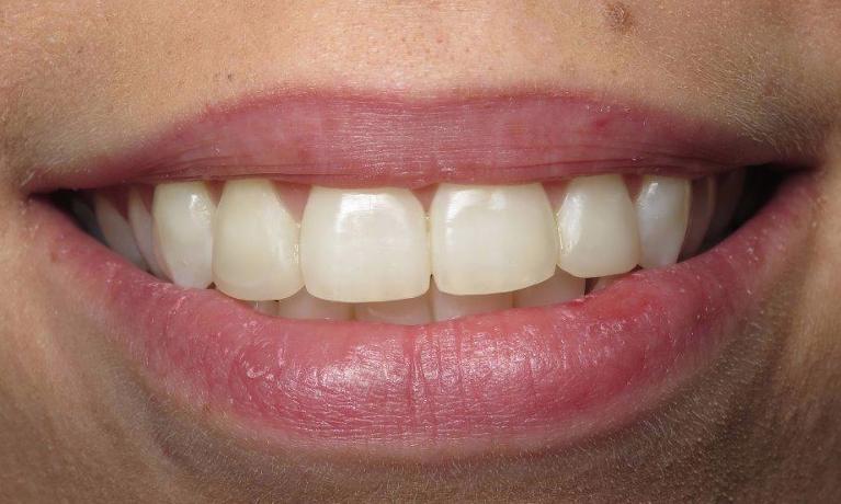 patient with new veneers in jonesboro ar