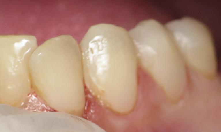 Patient with fixed tooth after bonding at Bartels Family Dentistry