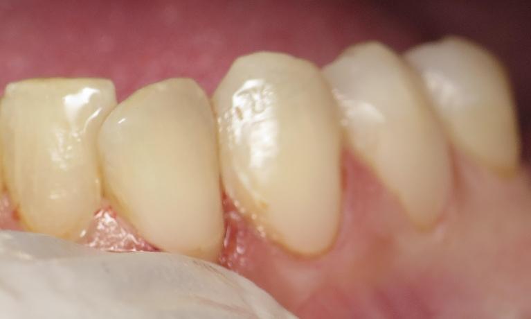 Dental-Bonding-in-Jonesboro-AR-After-Image