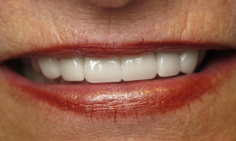 patient after replacing her old crowns in Jonesboro, AR
