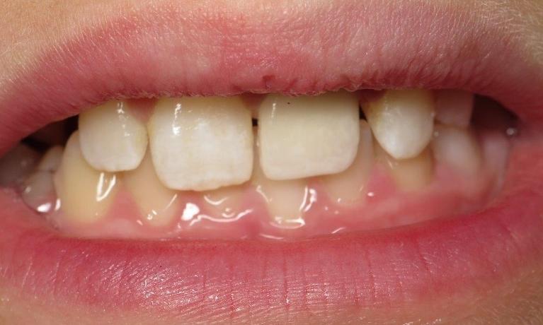 Child after receiving a porcelain crown at Bartels family Dentistry in Jonesboro