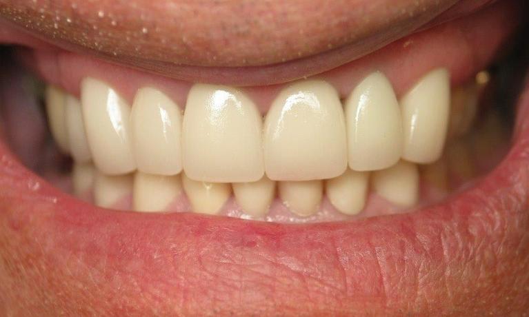 Patient smile after receiving veneers at Bartels Family Dentistry