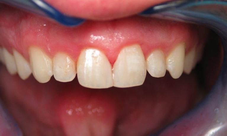 Patient after receiving composite bonding