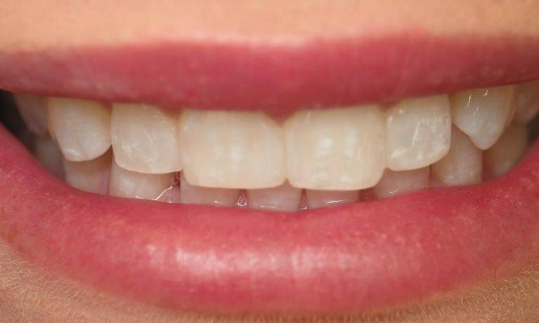 Patient with a fixed spacing issue after bonding