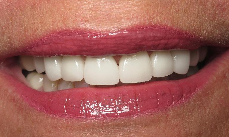 Porcelain-Crowns-in-Jonesboro-Arkansas-After-Image