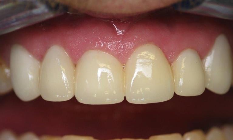 patient with new veneers in Jonesboro ar