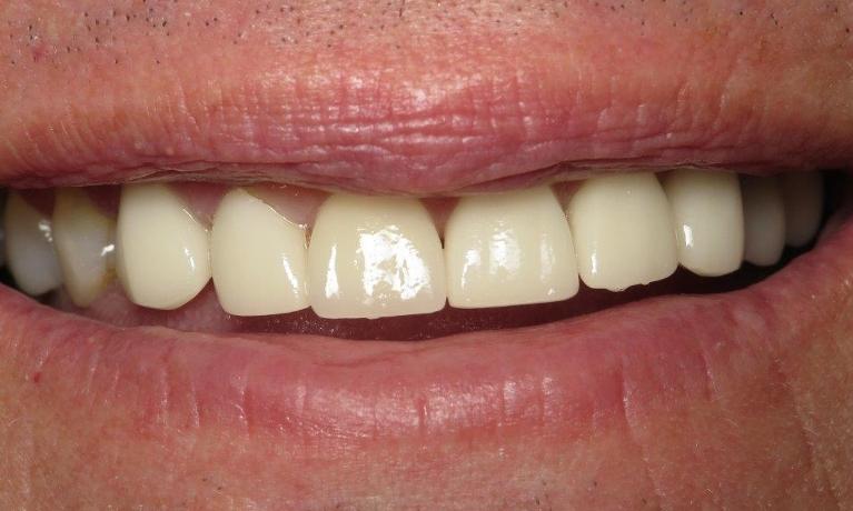 Porcelain-Crowns-in-Jonesboro-AR-After-Image