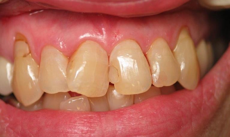 Patient teeth before veneers and crowns