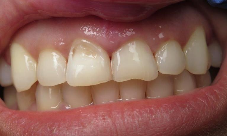 Patient before veneers | Jonesboro ar dentist