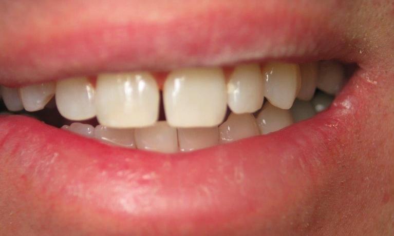 Patient with a diastema before bonding