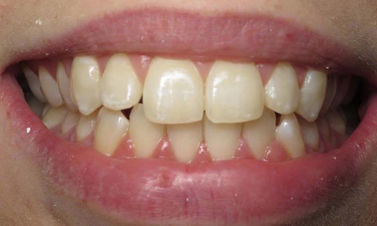 patient before veneers