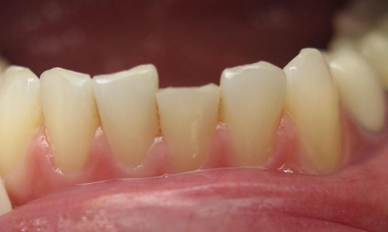 Patient with a chipped tooth before bonding