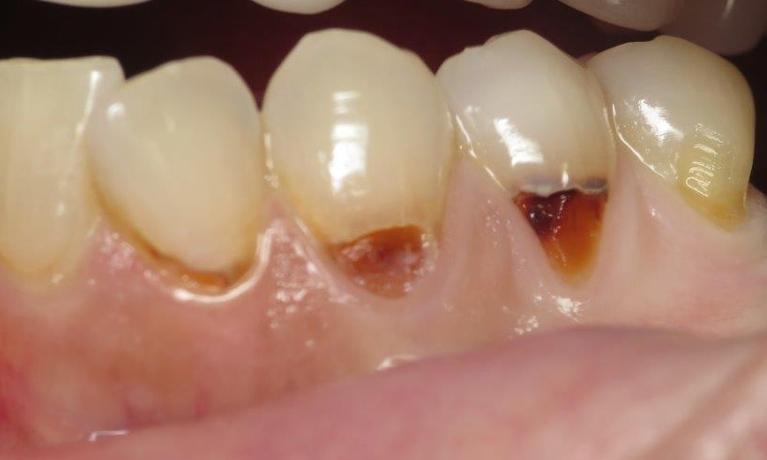 Dental-Bonding-in-Jonesboro-AR-Before-Image