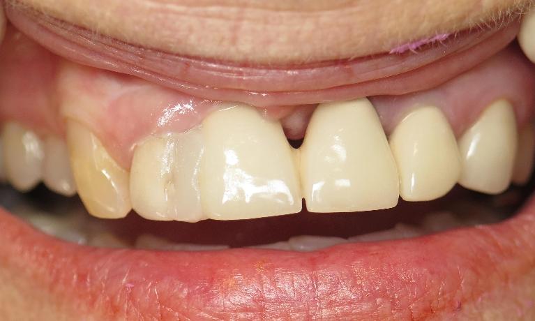 Patient before replacing her old crowns in Jonesboro, AR