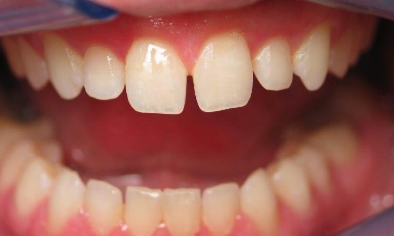 Patient with diastema before composite bonding
