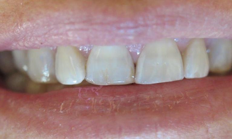 Porcelain-Crowns-in-Jonesboro-Arkansas-Before-Image