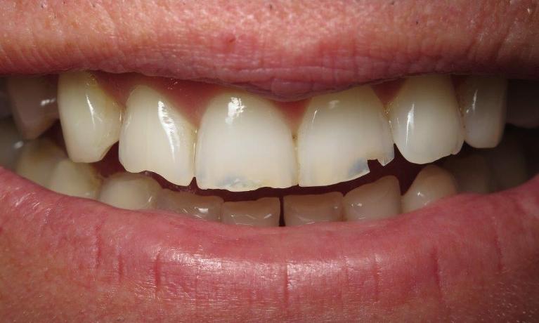Porcelain-Crowns-in-Jonesboro-AR-Before-Image