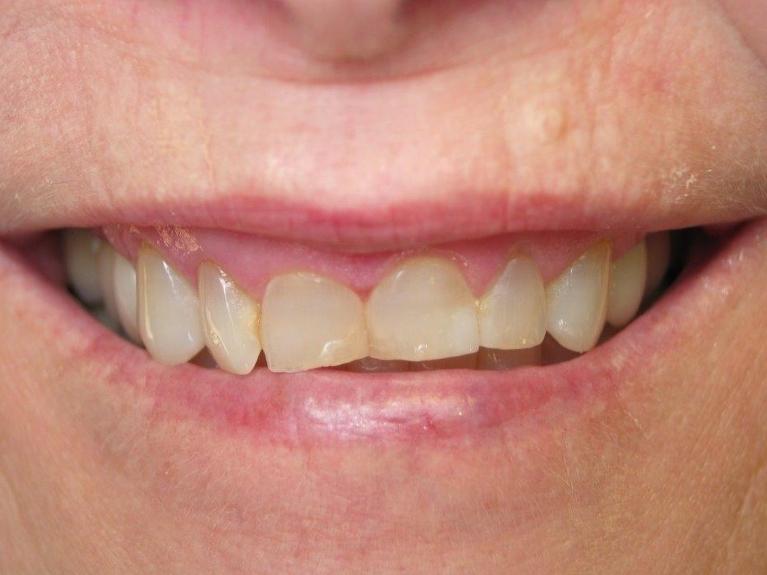 Patient before dental crowns | Jonesboro AR