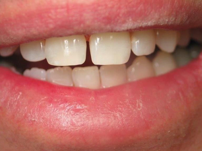 Before bonding | Cosmetic dentist jonesboro ar