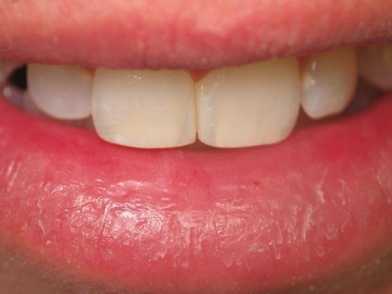 after dental bonding | jonesboro ar cosmetic dentist