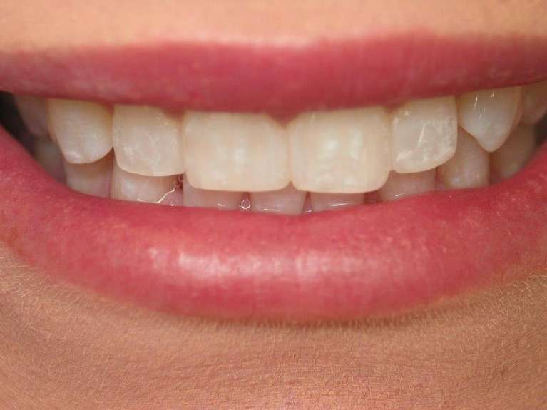 Cosmetic-Dentistry-After-Image