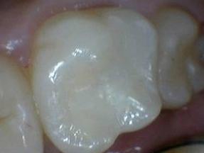 Tooth Colored Fillings Jonesboro AR